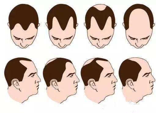 Over 70% of Post 90s Suffer from Hair Loss