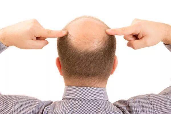 Over 70% of Post 90s Suffer from Hair Loss